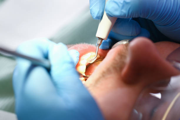 Best Chipped Tooth Repair Near Me  in Garrison, TX